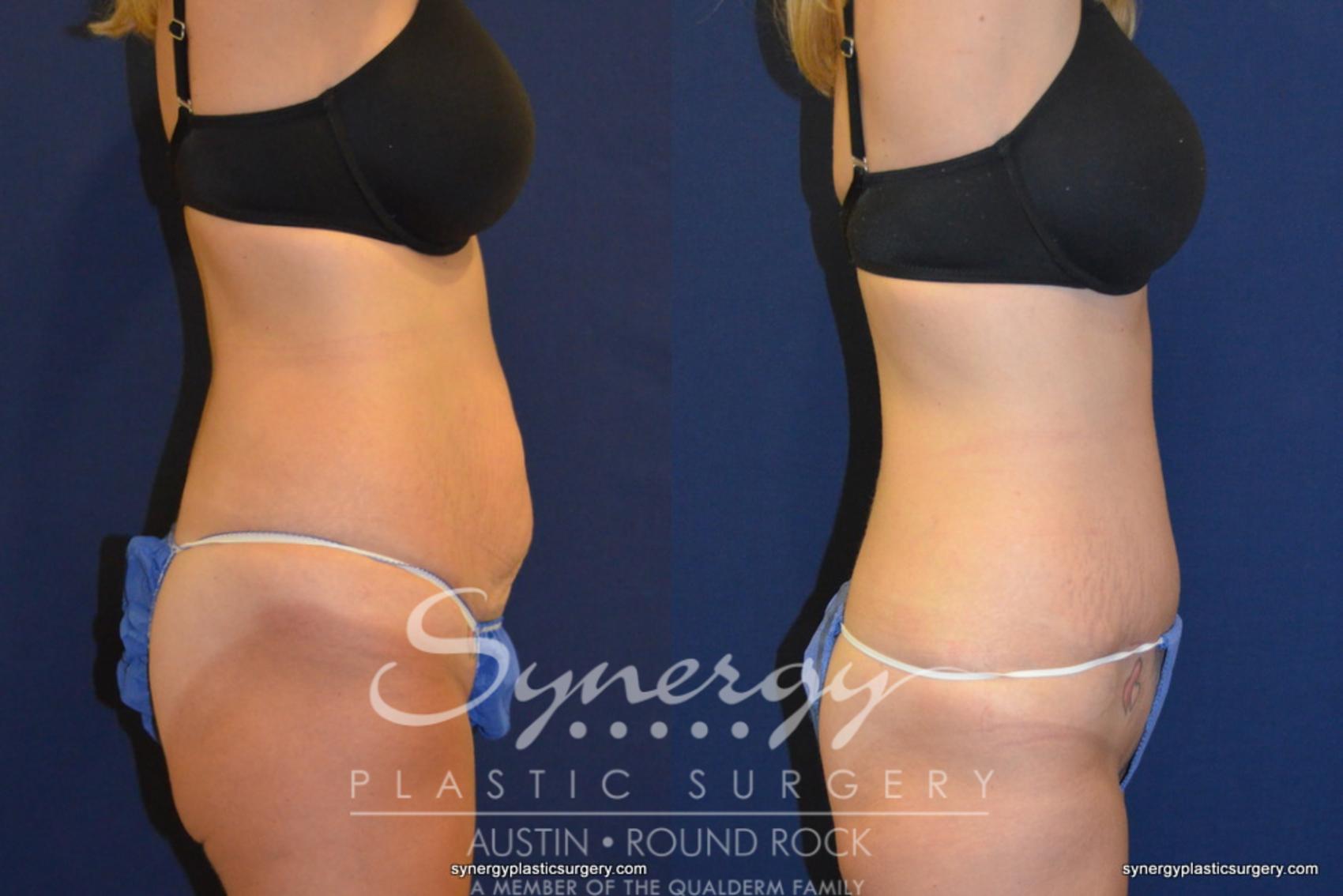 Before & After Abdominoplasty (Tummy Tuck) Case 246 View #1 View in Austin, TX