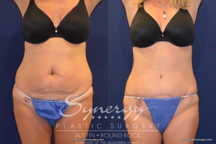 Before & After Abdominoplasty (Tummy Tuck) Case 246 View #2 View in Austin, TX