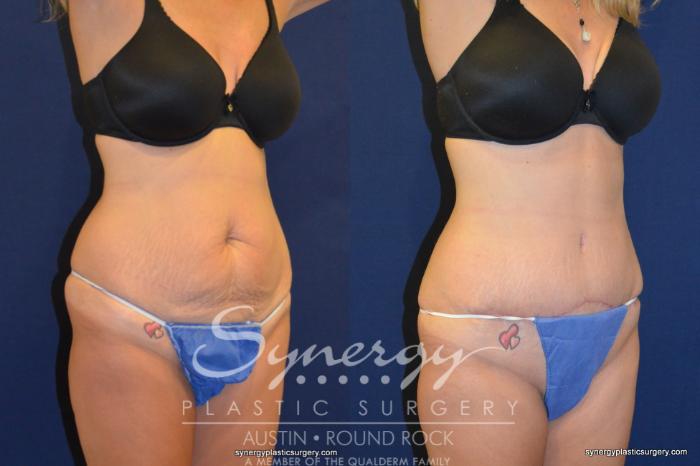 Before & After Abdominoplasty (Tummy Tuck) Case 246 View #3 View in Austin, TX