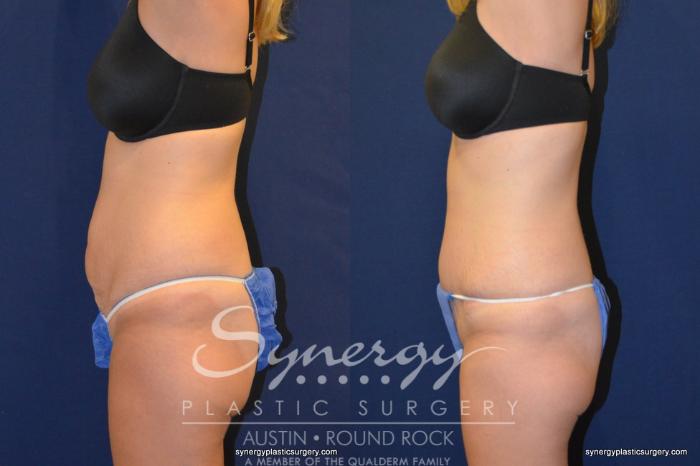 Before & After Abdominoplasty (Tummy Tuck) Case 246 View #4 View in Austin, TX