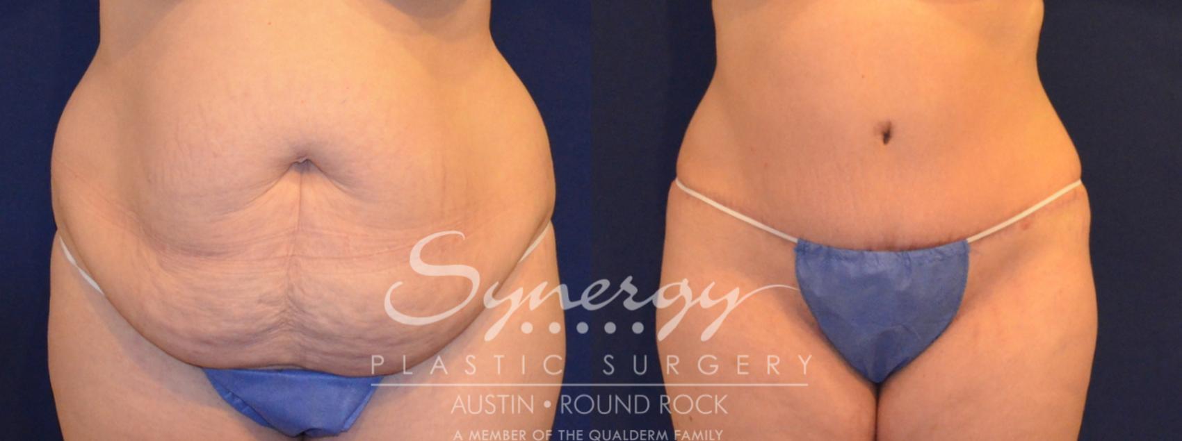 Before & After Abdominoplasty (Tummy Tuck) Case 292 View #1 View in Austin, TX