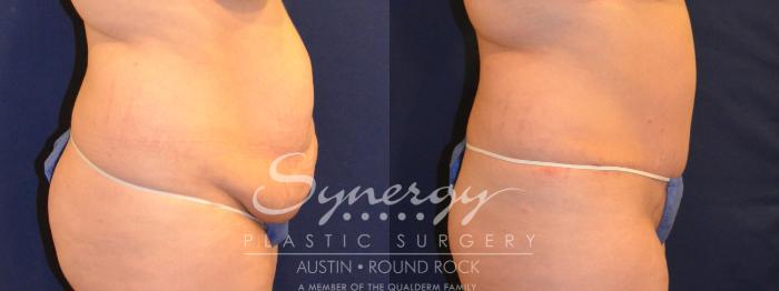 Before & After Abdominoplasty (Tummy Tuck) Case 292 View #3 View in Austin, TX