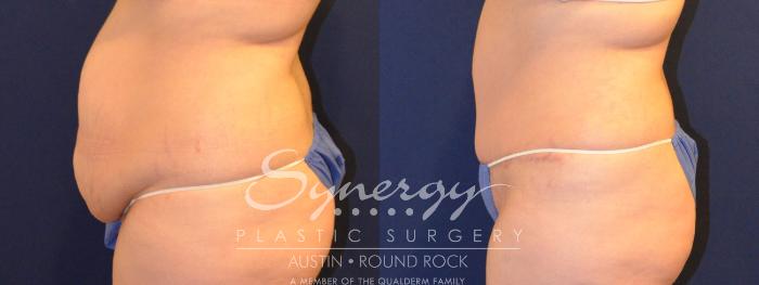 Before & After Abdominoplasty (Tummy Tuck) Case 292 View #5 View in Austin, TX