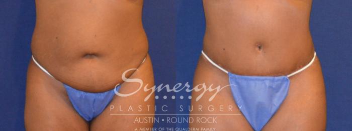 Before & After Abdominoplasty (Tummy Tuck) Case 299 View #1 View in Round Rock, TX