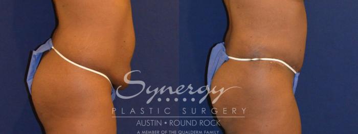 Before & After Abdominoplasty (Tummy Tuck) Case 299 View #2 View in Round Rock, TX