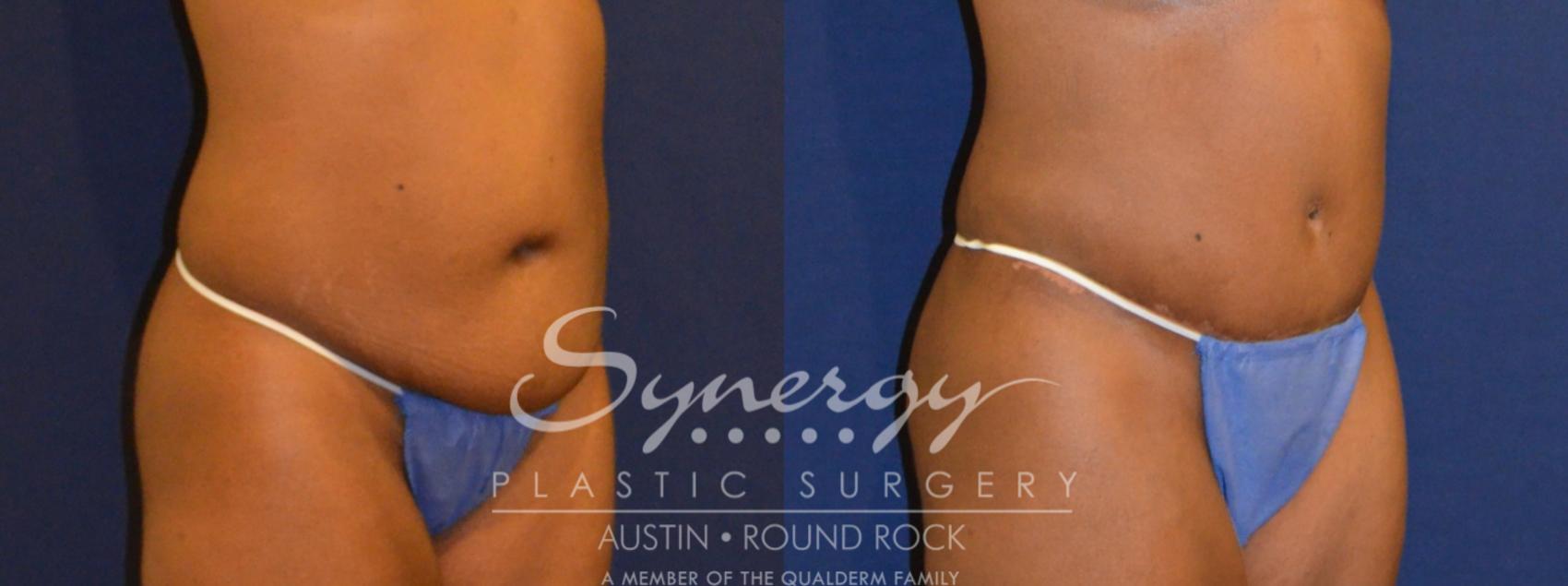 Before & After Abdominoplasty (Tummy Tuck) Case 299 View #3 View in Round Rock, TX