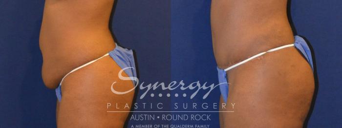 Before & After Abdominoplasty (Tummy Tuck) Case 299 View #4 View in Round Rock, TX