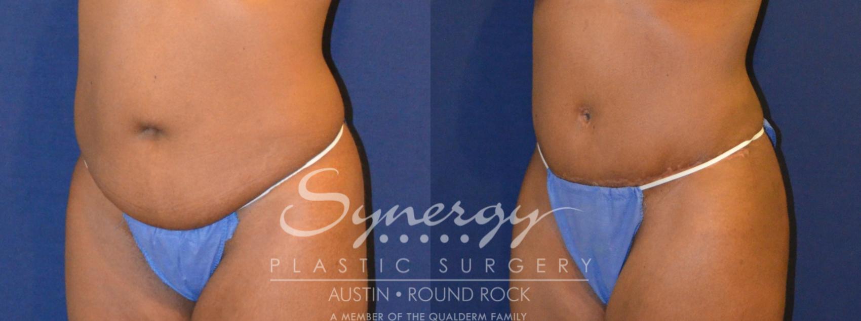Before & After Abdominoplasty (Tummy Tuck) Case 299 View #5 View in Round Rock, TX