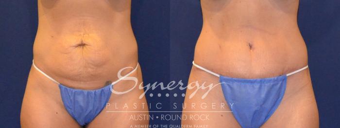 Before & After Abdominoplasty (Tummy Tuck) Case 302 View #1 View in Austin, TX
