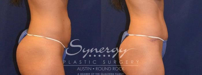 Before & After Abdominoplasty (Tummy Tuck) Case 302 View #2 View in Austin, TX