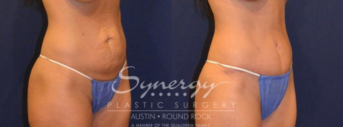 Before & After Abdominoplasty (Tummy Tuck) Case 302 View #3 View in Austin, TX