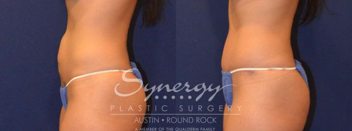 Before & After Abdominoplasty (Tummy Tuck) Case 302 View #4 View in Austin, TX