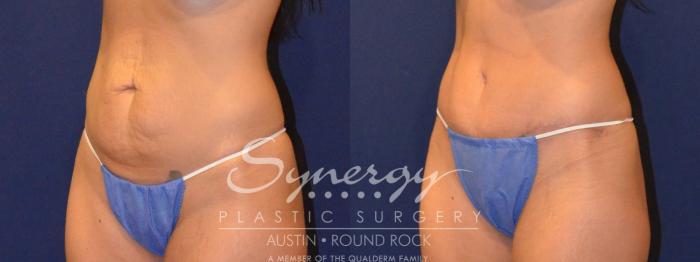 Before & After Abdominoplasty (Tummy Tuck) Case 302 View #5 View in Austin, TX