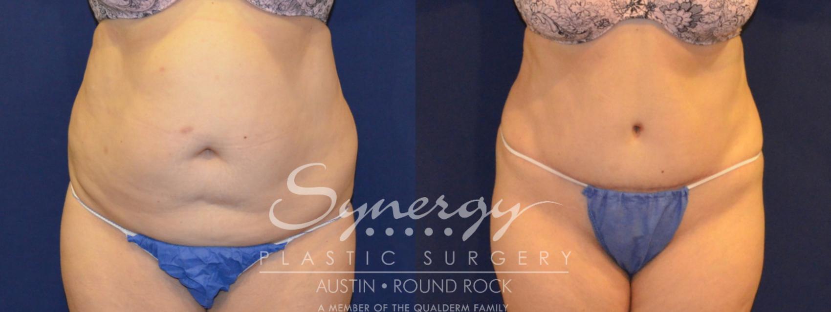 Abdominoplasty (Tummy Tuck) Before and After Pictures Case 306
