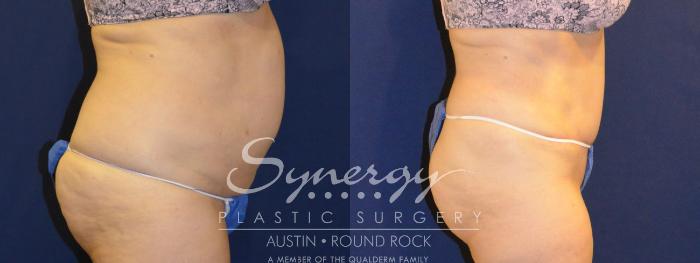 Before & After Abdominoplasty (Tummy Tuck) Case 306 View #2 View in Austin, TX