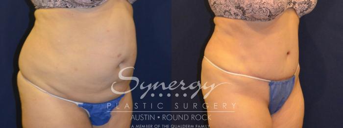 Before & After Abdominoplasty (Tummy Tuck) Case 306 View #3 View in Austin, TX