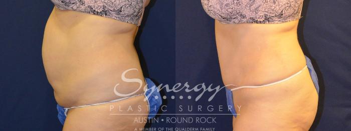 Before & After Abdominoplasty (Tummy Tuck) Case 306 View #4 View in Austin, TX