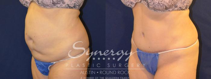Before & After Abdominoplasty (Tummy Tuck) Case 306 View #5 View in Austin, TX