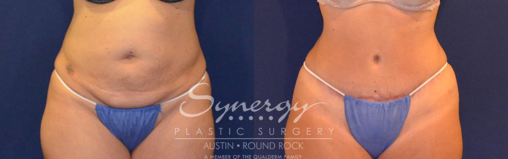 Before & After Abdominoplasty (Tummy Tuck) Case 308 View #1 View in Austin, TX