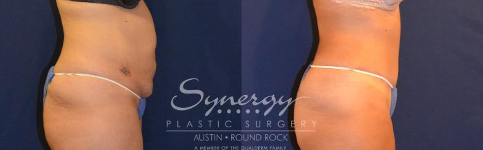 Before & After Abdominoplasty (Tummy Tuck) Case 308 View #2 View in Austin, TX