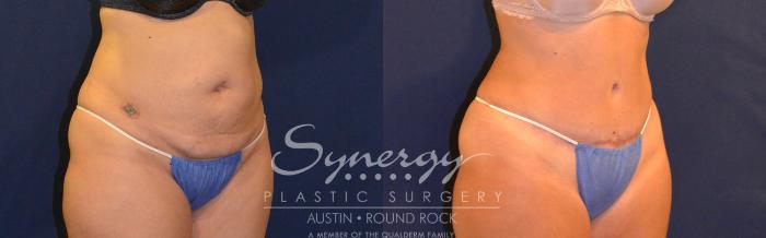 Before & After Abdominoplasty (Tummy Tuck) Case 308 View #3 View in Austin, TX