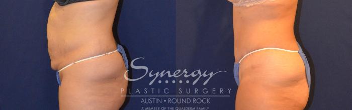 Before & After Abdominoplasty (Tummy Tuck) Case 308 View #4 View in Austin, TX