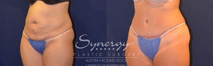 Before & After Abdominoplasty (Tummy Tuck) Case 308 View #5 View in Austin, TX