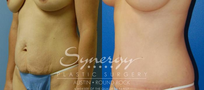 Before & After Abdominoplasty (Tummy Tuck) Case 33 View #3 View in Austin, TX