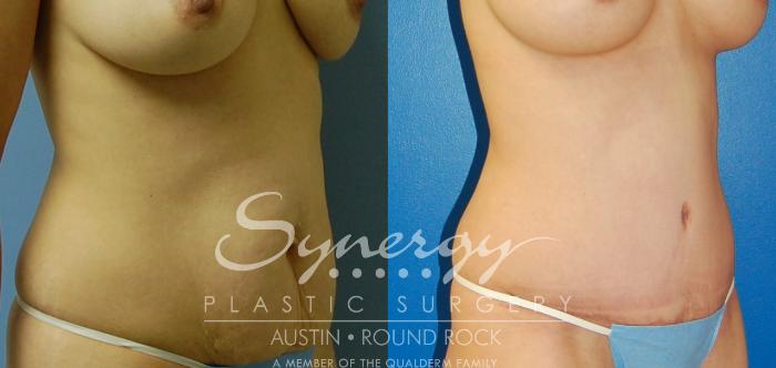 Before & After Abdominoplasty (Tummy Tuck) Case 33 View #4 View in Austin, TX