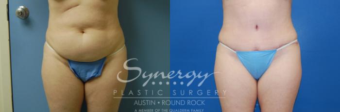 Before & After Abdominoplasty (Tummy Tuck) Case 4 View #1 View in Austin, TX