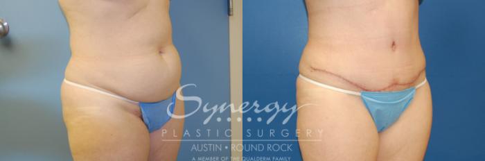 Before & After Abdominoplasty (Tummy Tuck) Case 4 View #2 View in Austin, TX