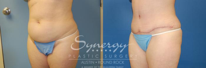 Before & After Abdominoplasty (Tummy Tuck) Case 4 View #3 View in Austin, TX