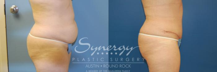 Before & After Abdominoplasty (Tummy Tuck) Case 4 View #4 View in Austin, TX
