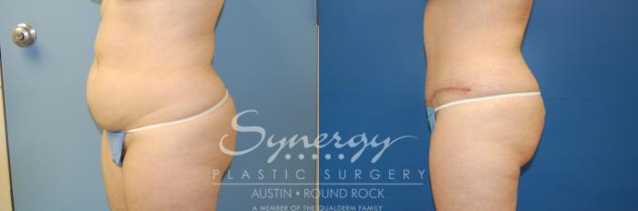 Before & After Abdominoplasty (Tummy Tuck) Case 4 View #5 View in Austin, TX