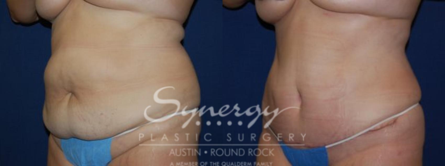 Before & After Abdominoplasty (Tummy Tuck) Case 42 View #1 View in Austin, TX