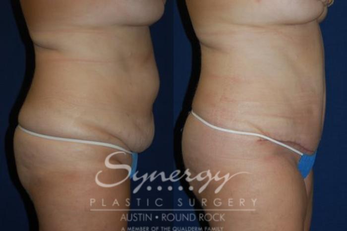 Before & After Abdominoplasty (Tummy Tuck) Case 42 View #2 View in Austin, TX