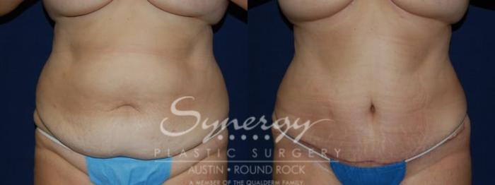 Before & After Abdominoplasty (Tummy Tuck) Case 42 View #4 View in Austin, TX