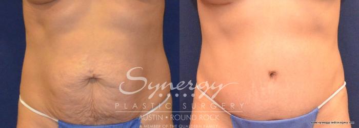 Before & After Abdominoplasty (Tummy Tuck) Case 429 View #1 View in Austin, TX