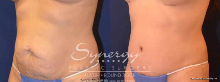 Before & After Abdominoplasty (Tummy Tuck) Case 429 View #2 View in Austin, TX