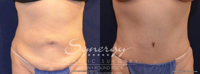Before & After Abdominoplasty (Tummy Tuck) Case 445 View #1 View in Austin, TX
