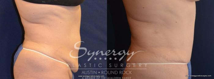 Before & After Abdominoplasty (Tummy Tuck) Case 445 View #2 View in Austin, TX