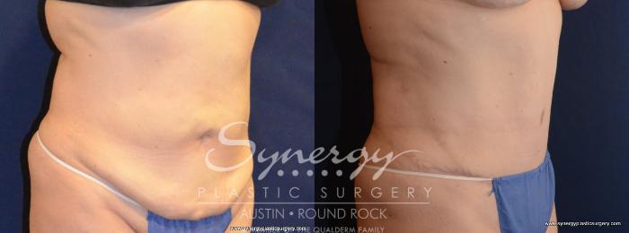 Before & After Abdominoplasty (Tummy Tuck) Case 445 View #3 View in Austin, TX