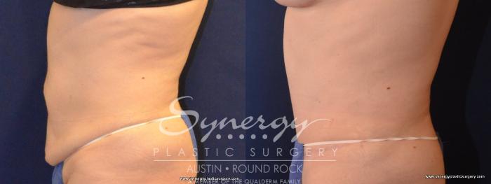 Before & After Abdominoplasty (Tummy Tuck) Case 445 View #4 View in Austin, TX