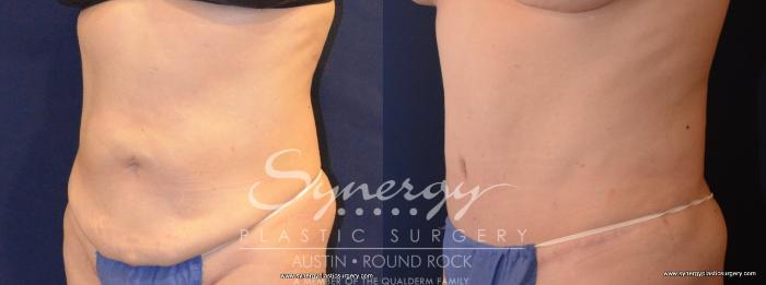 Before & After Abdominoplasty (Tummy Tuck) Case 445 View #5 View in Austin, TX