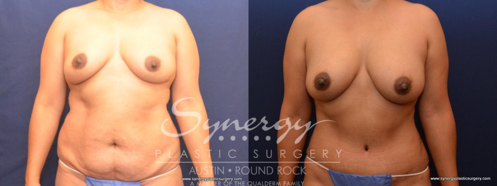Before & After Abdominoplasty (Tummy Tuck) Case 446 View #1 View in Austin, TX