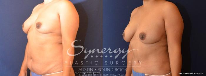 Before & After Abdominoplasty (Tummy Tuck) Case 446 View #2 View in Austin, TX