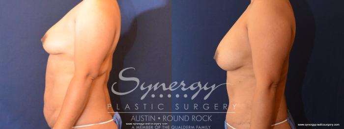 Before & After Abdominoplasty (Tummy Tuck) Case 446 View #3 View in Austin, TX