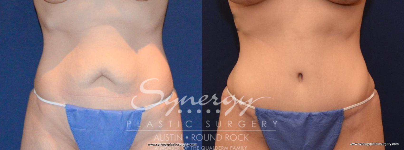 Before & After Abdominoplasty (Tummy Tuck) Case 455 View #1 View in Austin, TX