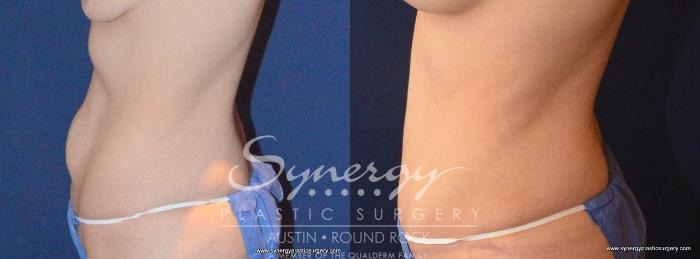 Before & After Abdominoplasty (Tummy Tuck) Case 455 View #2 View in Austin, TX