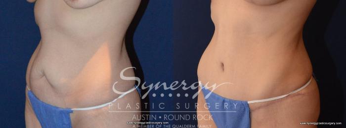 Before & After Abdominoplasty (Tummy Tuck) Case 455 View #3 View in Austin, TX